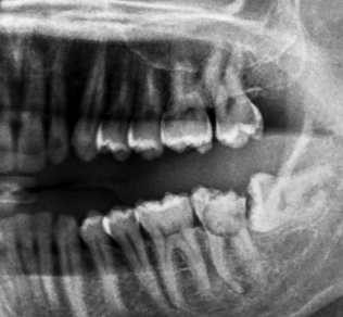 teeth x-ray